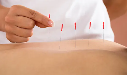 Acupuntura